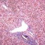 Ductular proliferation after massive hepatic necrosis