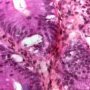 Colonoc GVHD