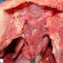 Bilateral pulmonary hypoplasia