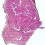 Mammary fibroadenoma