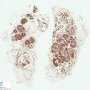 Lobular capillary hemangioma