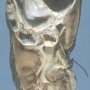Cystic nephroma