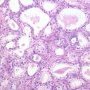 Atypical Adenomatous Hyperplasia