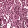 Abdominal desmoplastic small round cell tumor