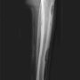 From Bullough's Orthopaedic Pathology
