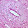 Invasive lobular carcinoma of the breast (Credit Ed Uthman)