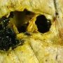 Cystic dilatation of a main bile duct in extrahepatic biliary tract (...)