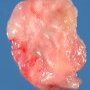 Invasive pulmonary aspergillosis