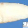 Mammary fibroadenoma