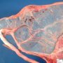 Velamentous insertion of umbilical cord