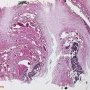 Nail involvment in psoriais