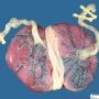 Dichorionic diamniotic gemellar placenta