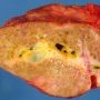 Dilatation of main bile ducts in extrahepatic biliary tract (...)
