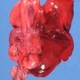 Left diaphragmatic hernia (fetus, 25 weeks)