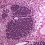 Blastemal component in Wilms tumor