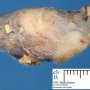 Nodal epidermoid cyst