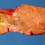 Dilatation of main bile ducts in extrahepatic biliary tract (...)