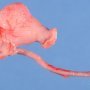 Ileal duplication cyst