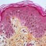 Cutaneous GVHD grade 2