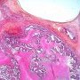 Embryonal carcinoma