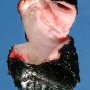Duodenal duplication cyst