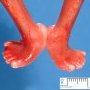 Rocker-bottom feet in trisomy 13