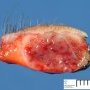 Lobular capillary hemangioma