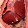 Bilateral congenital diaphragmatic hernia