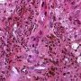 Epithelial dysplasia of interlobular biliary tract in chronic hepatic (...)
