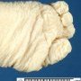 Foot oligodactyly
