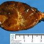 Adrenal pheochromocytoma (Adrenal paraganglioma)