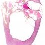Cystic nephroma