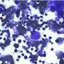 Parvovirus B19 cytopathogenic effect in bone marrow