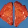 Focal nodular hyperplasia in sickle cell anemia