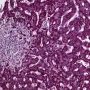 Hepatic granuloma in CVID with Mycobacterium avium infection