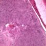 Basaloid pilomatricoma