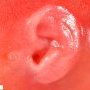 Preauricular appendix in a malformative syndrome (20 weeks)