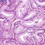 Gleason Pattern 3 - Large variant (WebPathology)