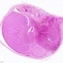 Testicular torsion