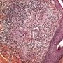 Dermal epithelioid granulomas