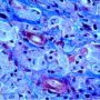 Carbohydrate-laden macrophages in GSD4