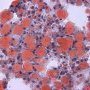 Macrovesicular hepatocytic steatosis (Oil-Red-O)
