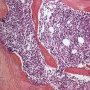 Normal bone marrow