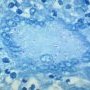 Ziehl–Neelsen stain (acid-fast stain) - Courtesy of Dr Yale Rosen