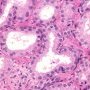 Atypical Adenomatous Hyperplasia