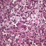 Foamy macrophages in splenic red pulp
