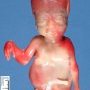 Caudal dysplasia with limb agenesis