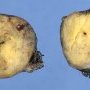clear cell myomelanocytic tumor of falciform ligament