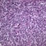 Monophasic synovial sarcoma