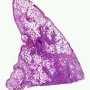 Pulmonary perivascular lymphoplasmocytic infiltrate and perivascular (...)
